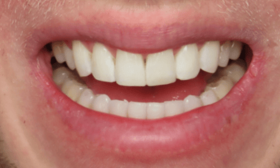 After treatment - Clear Aligners and Composite Bonding