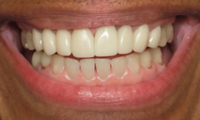 After treatment - Clear Aligners and Crowns