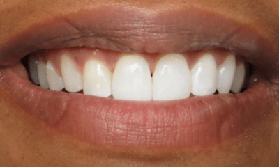 After treatment - Clear Aligners and Whitening