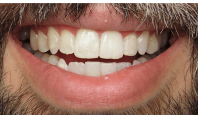 After treatment - Clear Aligners and Whitening