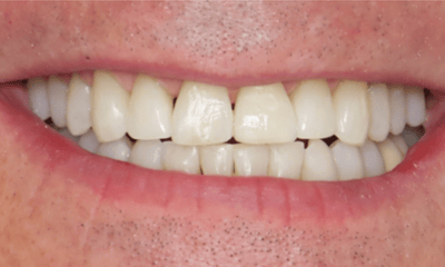 After treatment - Clear Aligners, Whitening, and Bioclear