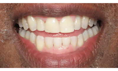 After treatment - Clear Aligners, Whitening, and Composite Bonding