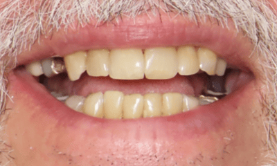 After treatment - Clear Aligners, Whitening, and Composite Bonding