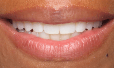After treatment - Clear Aligners
