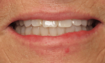 After treatment - Clear Aligners