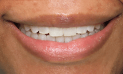 After treatment - Clear Aligners 