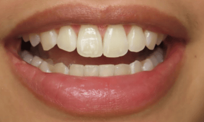 After treatment - Clear Aligners