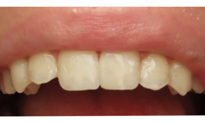 After treatment - Composite Bonding