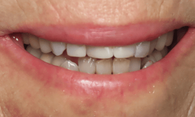 After treatment - Composite Bonding