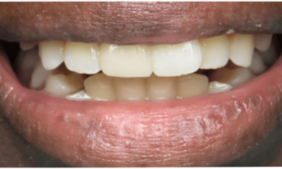 After treatment - Composite Bonding
