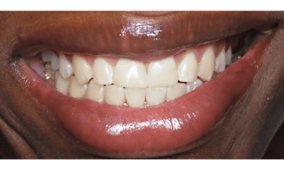 After treatment - Composite Bonding