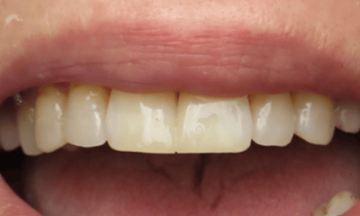 After treatment - Composite Bonding