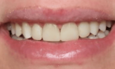 After treatment - Composite Veneers