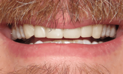 After treatment - Composite Veneers