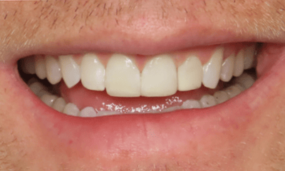 After treatment - Clear Aligners and Composite Bonding