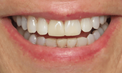 After treatment - Clear Aligners and Composite Veneers