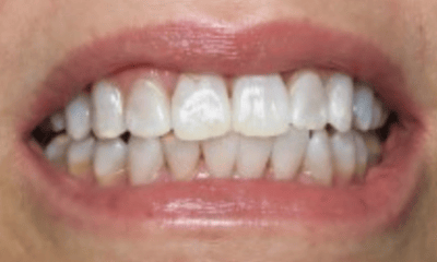 After treatment - KöR in Office Whitening