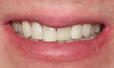 Before treatment - Clear Aligners and Composite Bonding