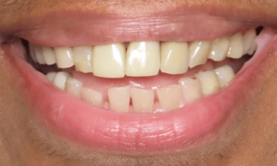 Before treatment - Clear Aligners and Crowns
