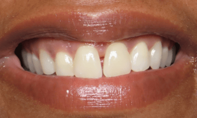 Before treatment - Clear Aligners and Whitening