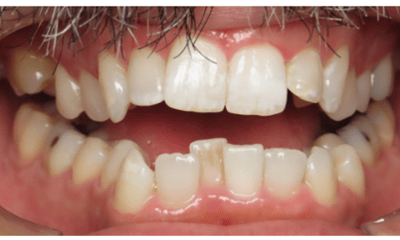 Before treatment - Clear Aligners and Whitening