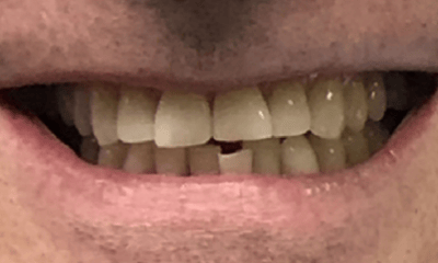 Before treatment - Clear Aligners, Whitening, and Bioclear