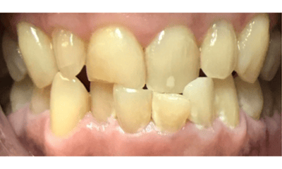 Before treatment - Clear Aligners, Whitening, and Composite Bonding