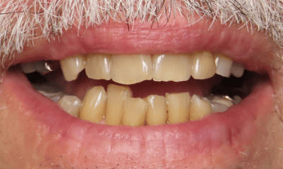 Before treatment - Clear Aligners, Whitening, and Composite Bonding