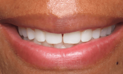 Before treatment - Clear Aligners