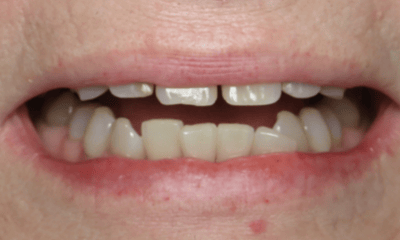 Before treatment - Clear Aligners