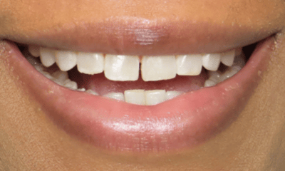 Before treatment - Clear Aligners 