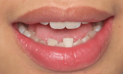 Before treatment - Clear Aligners
