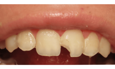 Before treatment - Composite Bonding