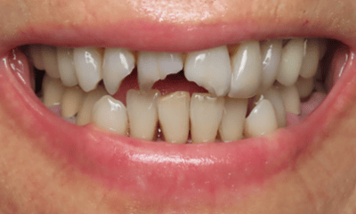 Before treatment - Composite Bonding