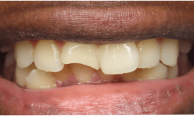 Before treatment - Composite Bonding
