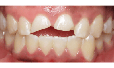 Before treatment - Composite Bonding