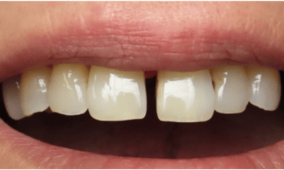 Before treatment - Composite Bonding