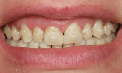 Before treatment - Composite Veneers