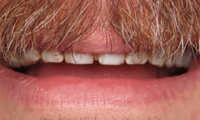 Before treatment - Composite Veneers