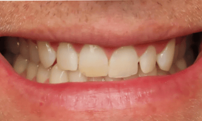 Before treatment - Clear Aligners and Composite Bonding