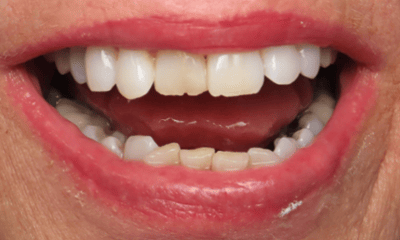 Before treatment - Clear Aligners and Composite Veneers
