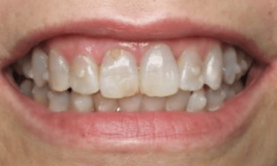 Before treatment - KöR in Office Whitening