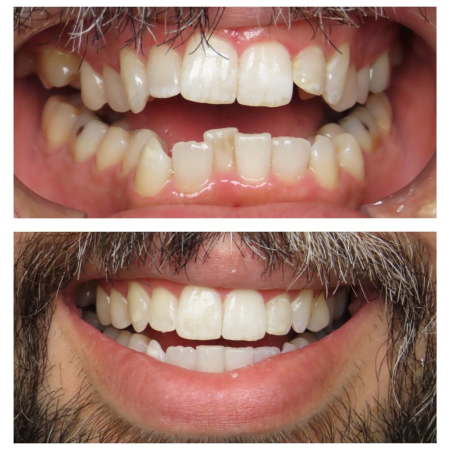 Patient smile after clear aligners and teeth whitening