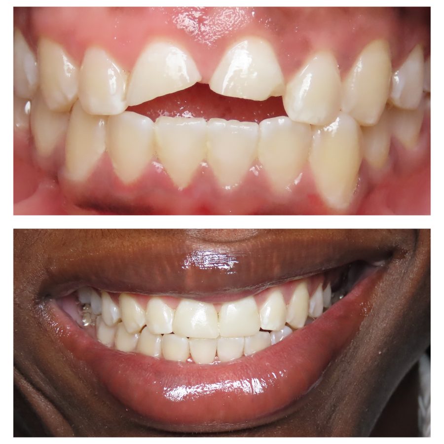 Patient smile after composite bonding treatment