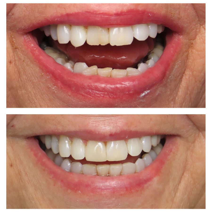 Patient smile after Invisalign and composite veneers