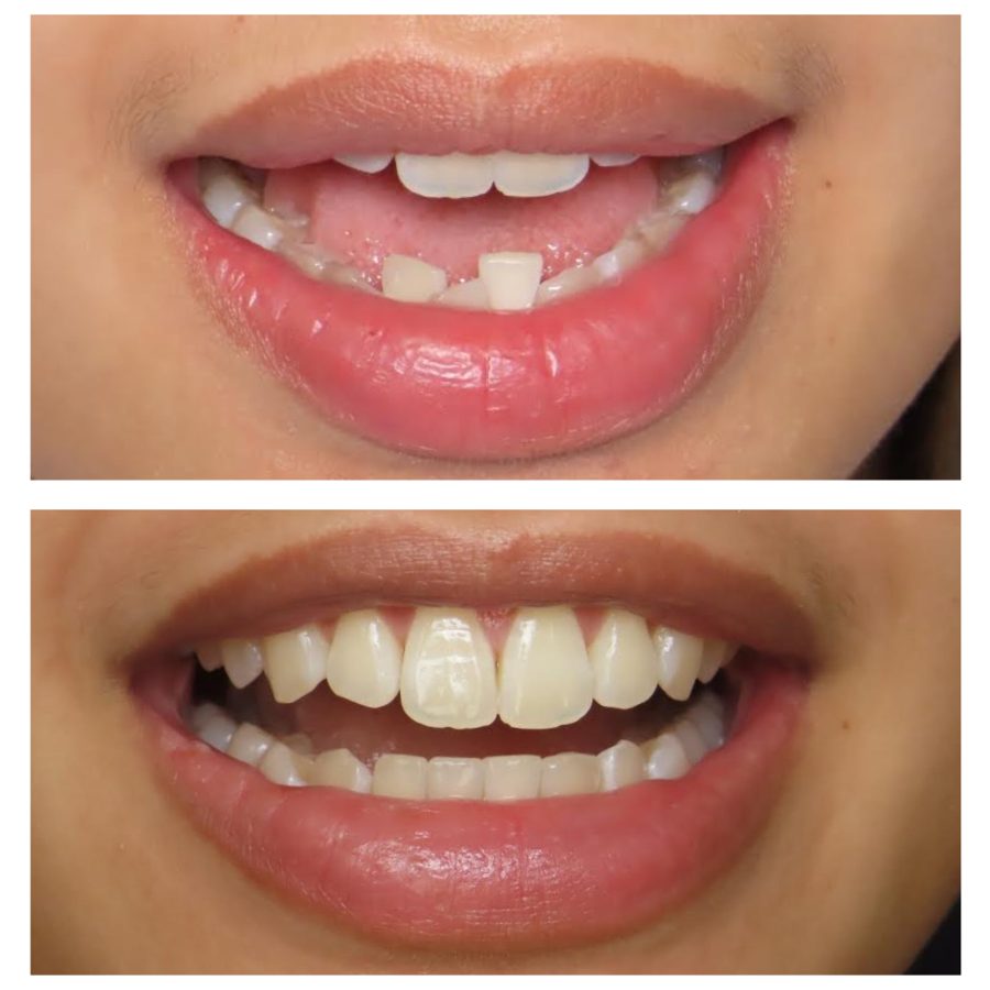 Patient smile after clear aligner treatment