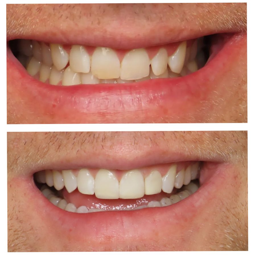 Patient smile makeover result at Harbortown Dental Care