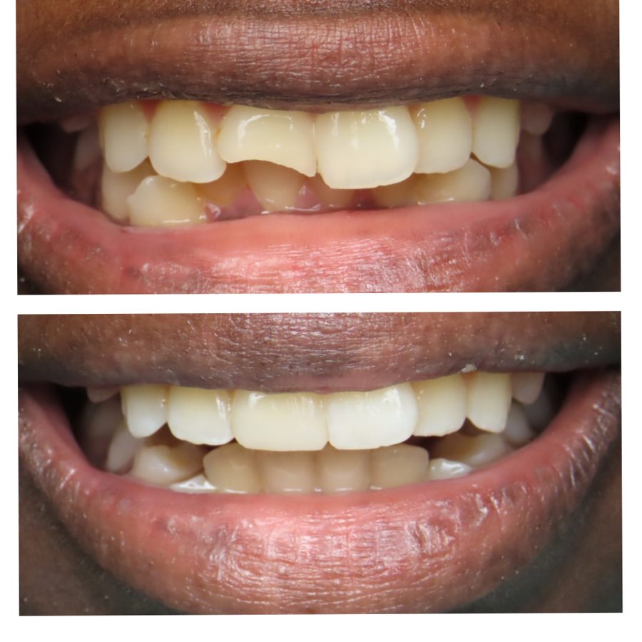Patient smile makeover result at Harbortown Dental Care